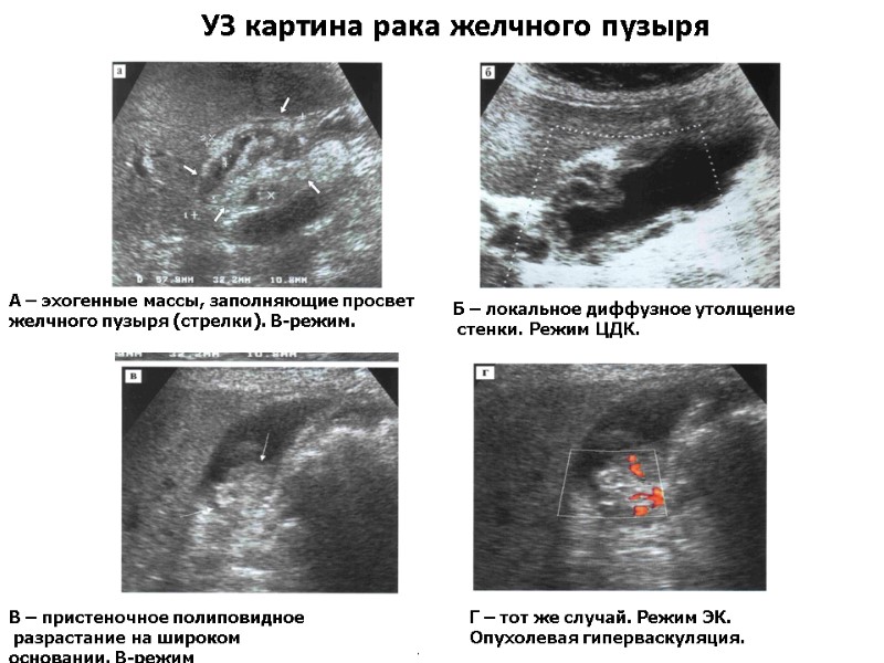 УЗ картина рака желчного пузыря    .  А – эхогенные массы,